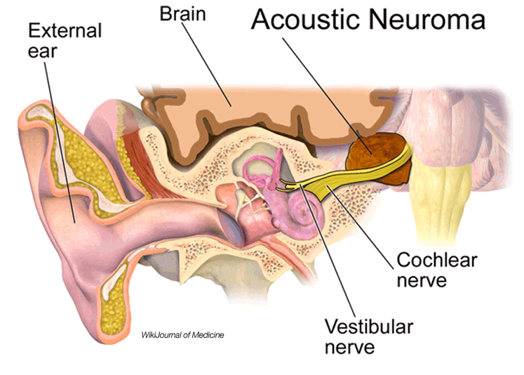 Acoustic Neuroma