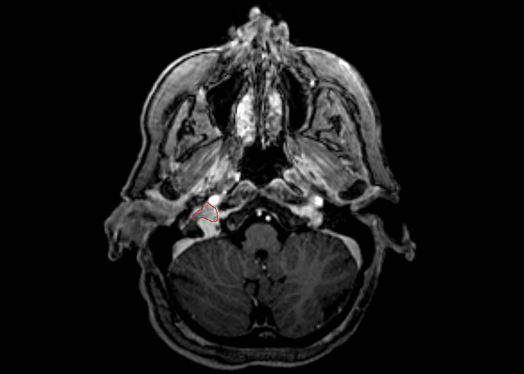 Glomus Jugulare Tumor